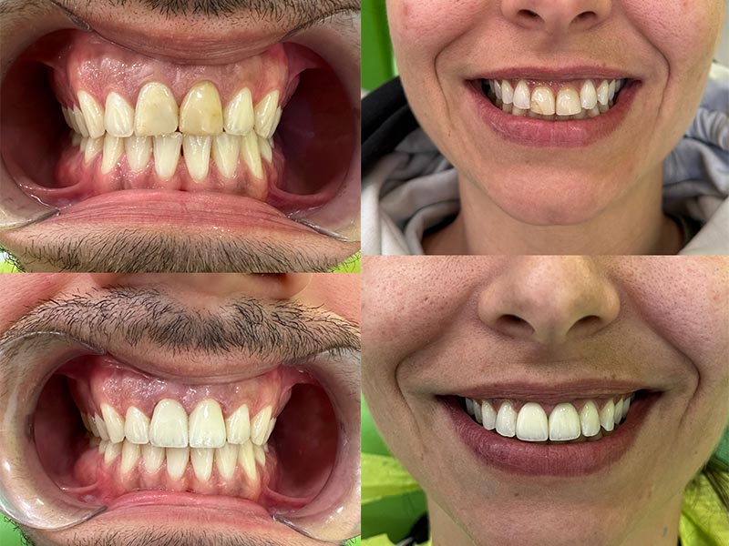 Bezmetalne-krunice-Cetkovic-dental-studio-Novi-Sad-2